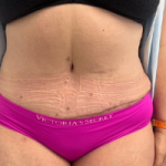 Abdominoplasty Before & After Patient #7727