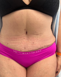 Abdominoplasty Before & After Patient #7727