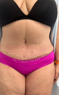 Abdominoplasty Before & After Patient #7727