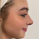 Rhinoplasty Before & After Patient #7713