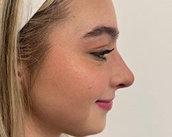 Rhinoplasty Before & After Patient #7713