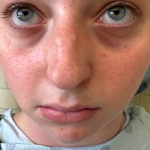 Rhinoplasty Before & After Patient #7713