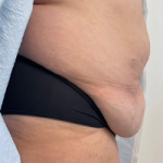 Abdominoplasty Before & After Patient #7727