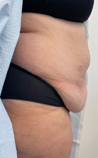 Abdominoplasty Before & After Patient #7727