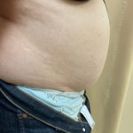 Abdominoplasty Before & After Patient #7728