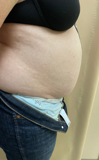 Abdominoplasty Before & After Patient #7728