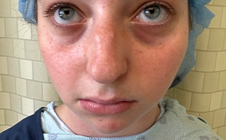 Rhinoplasty Before & After Patient #7713