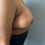 Breast Reduction Before & After Patient #7720