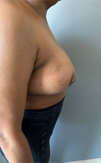 Breast Reduction Before & After Patient #7720