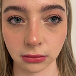 Rhinoplasty Before & After Patient #7713