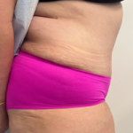Abdominoplasty Before & After Patient #7727