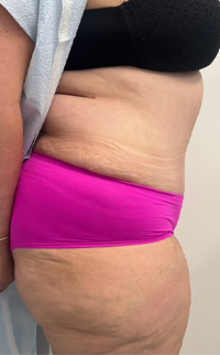 Abdominoplasty Before & After Patient #7727