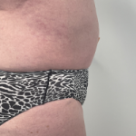 Abdominoplasty Before & After Patient #7728
