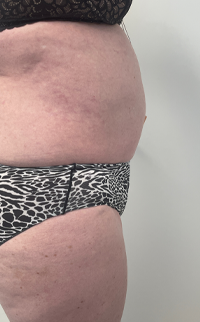 Abdominoplasty Before & After Patient #7728