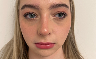 Rhinoplasty Before & After Patient #7713