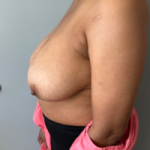 Breast Reduction Before & After Patient #7720