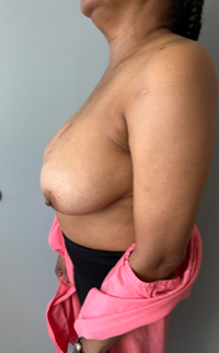 Breast Reduction Before & After Patient #7720