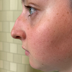 Rhinoplasty Before & After Patient #7713