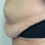 Abdominoplasty Before & After Patient #7727