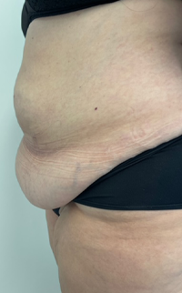 Abdominoplasty Before & After Patient #7727