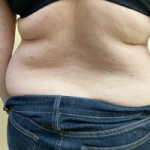 Abdominoplasty Before & After Patient #7728