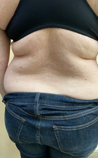 Abdominoplasty Before & After Patient #7728