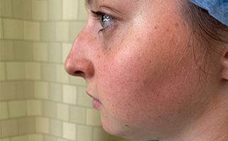 Rhinoplasty Before & After Patient #7713
