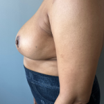 Breast Reduction Before & After Patient #7720