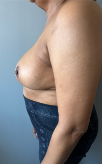 Breast Reduction Before & After Patient #7720