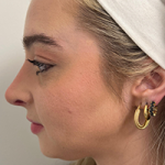 Rhinoplasty Before & After Patient #7713