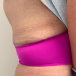 Abdominoplasty Before & After Patient #7727