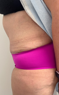 Abdominoplasty Before & After Patient #7727