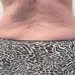 Abdominoplasty Before & After Patient #7728