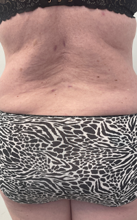 Abdominoplasty Before & After Patient #7728