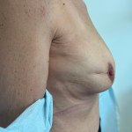 Breast Reconstruction Before & After Patient #8742