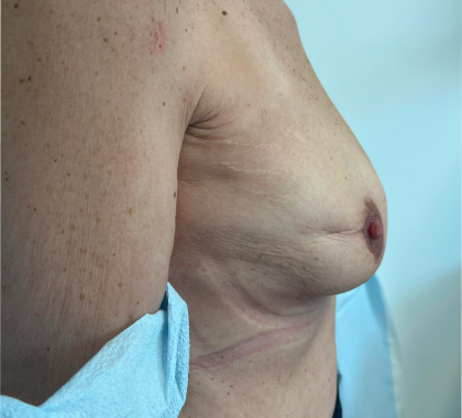 Breast Reconstruction Before & After Patient #8742