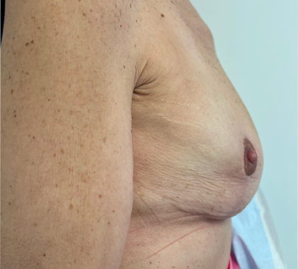 Breast Reconstruction Before & After Patient #8742