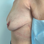 Breast Reconstruction Before & After Patient #8742