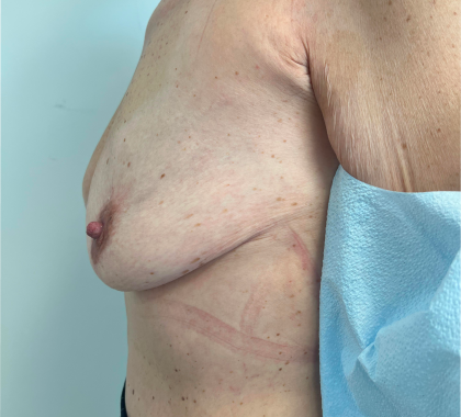 Breast Reconstruction Before & After Patient #8742