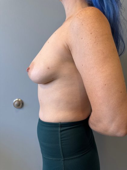Breast Reconstruction Before & After Patient #8735