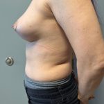 Breast Reconstruction Before & After Patient #8735