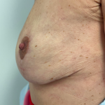 Breast Reconstruction Before & After Patient #8742