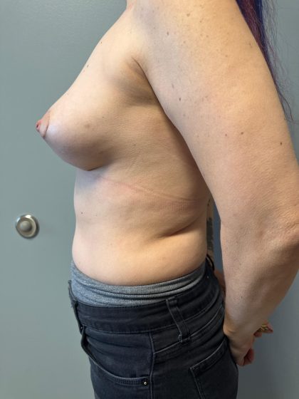 Breast Reconstruction Before & After Patient #8735