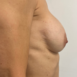 Breast Revision Before & After Patient #8768