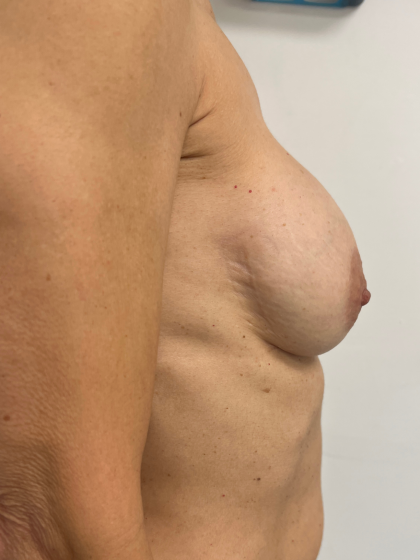 Breast Revision Before & After Patient #8768