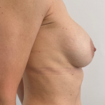 Breast Revision Before & After Patient #8768