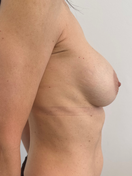 Breast Revision Before & After Patient #8768