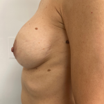 Breast Revision Before & After Patient #8768
