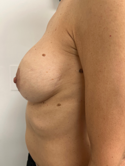 Breast Revision Before & After Patient #8768