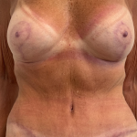 Breast Augmentation Before & After Patient #8792